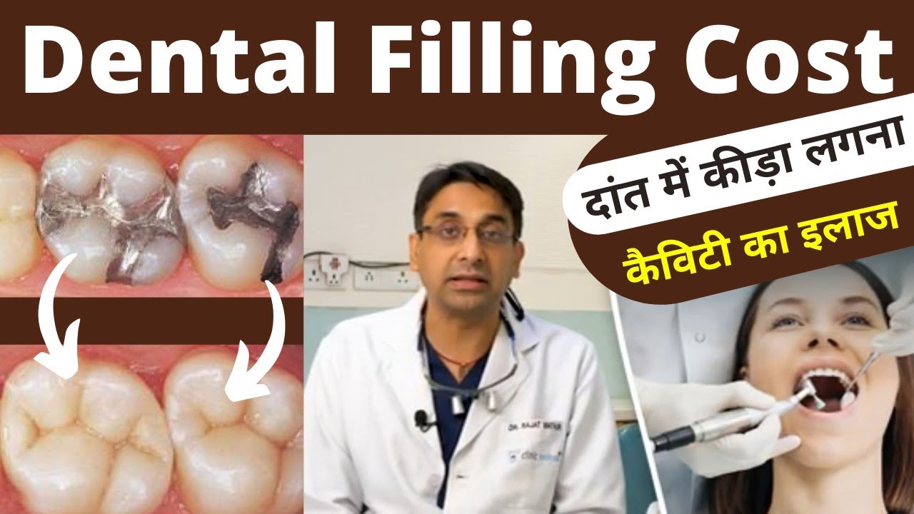 Dental Cavity/Filling Procedure, Treatment And Cost In Hindi
